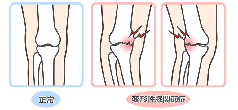 変形性膝関節症の原因