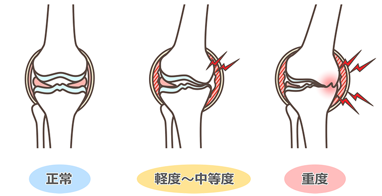 変形性膝関節症の症状がひどくなるとどうなる？