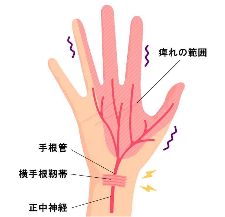 指や手が痺れる「手根管症候群」