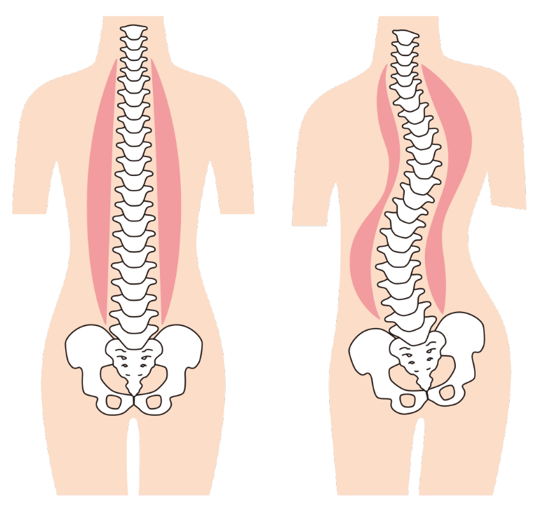 背骨が曲がっていると言われた…