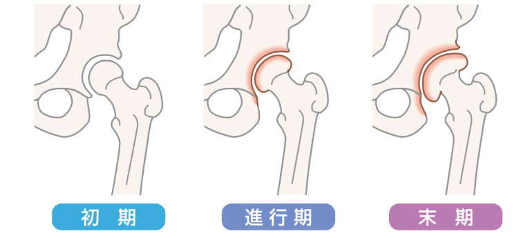 変形性股関節症の初期症状とは