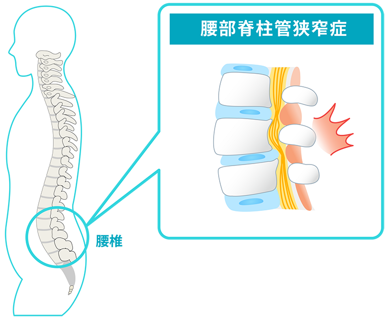 腰部脊柱管狭窄症