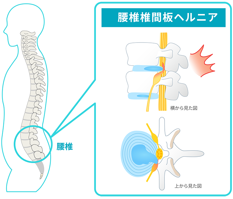 腰椎椎間板ヘルニア